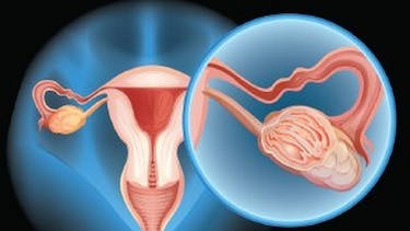 Atención al cáncer de ovario