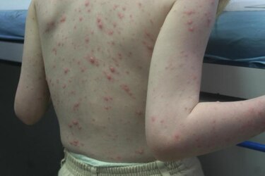 Brote de varicela en escuelas chitreanas