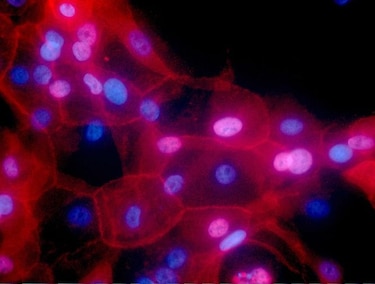 Inmunoterapia avanza en batalla contra el cáncer de mama