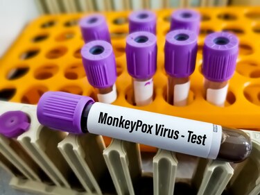 Minsa confirma tres nuevos casos de mpox; hay 59 en total