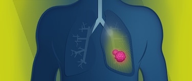 Cáncer de pulmón: el alto costo de un diagnóstico que llega tarde