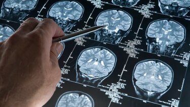Nuevo revés en el tratamiento de la enfermedad de Alzheimer