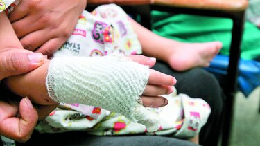 Prevenir las quemaduras en los hogares