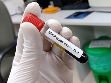 Viruela del mono podría afectar con mayor gravedad a personas con VIH avanzado: ‘The Lancet’
