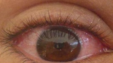 Se reportan 2 mil 719 casos de conjuntivitis