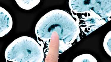 IA podría ser clave para  cirugía de tumores cerebrales