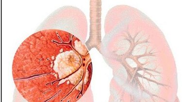 Investigadores españoles encuentran una nueva diana contra el cáncer