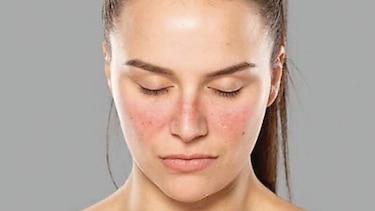 Prueban eficacia de test para predecir recaída de lupus