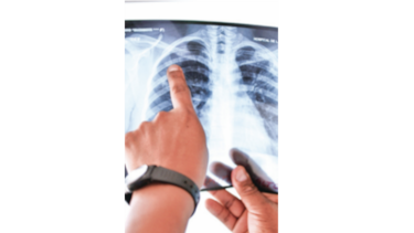 Se establecen normas clínicas  para manejo de pacientes  con tuberculosis drogoresistente 