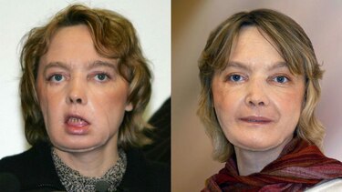 Fallece primera paciente de trasplante facial en el mundo
