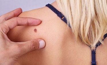 Presentan #SoySkinChecker, una campaña contra el cáncer de piel