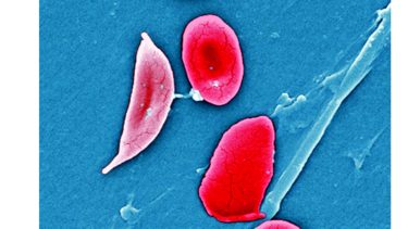 Avances en la anemia
