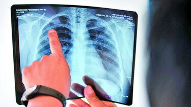 Se incrementan los casos de tuberculosis, advierte el Minsa
